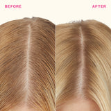 Before and after comparison of hairline treatment showing a smoother and more defined hairline.